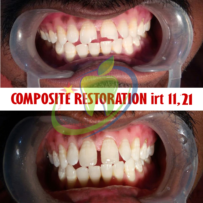 composite veneers